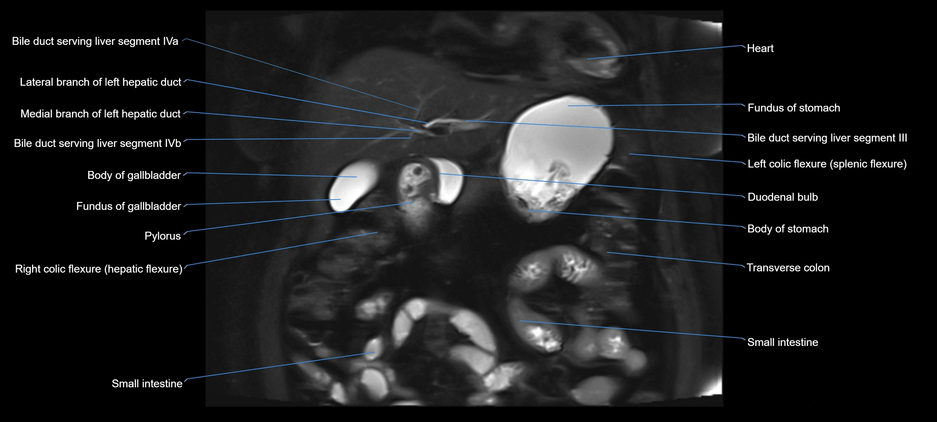MRI MRCP coronal cross sectional 3T radiology  image-img-00001-00007.webp